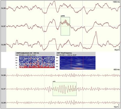 Automatic vs. Manual Detection of High Frequency Oscillations in Intracranial Recordings From the Human Temporal Lobe